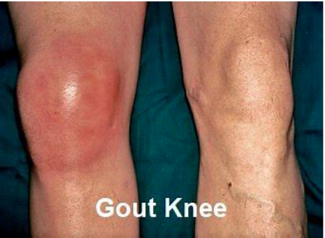 Gout Awareness – AAKP